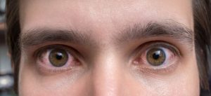 do humidifiers help with dry eyes