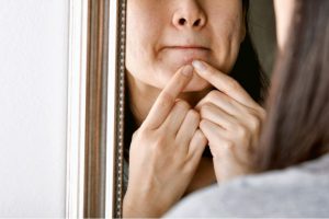 dry skin acne