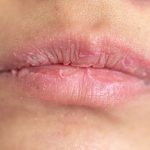 Can a Humidifier Help With Chapped Lips