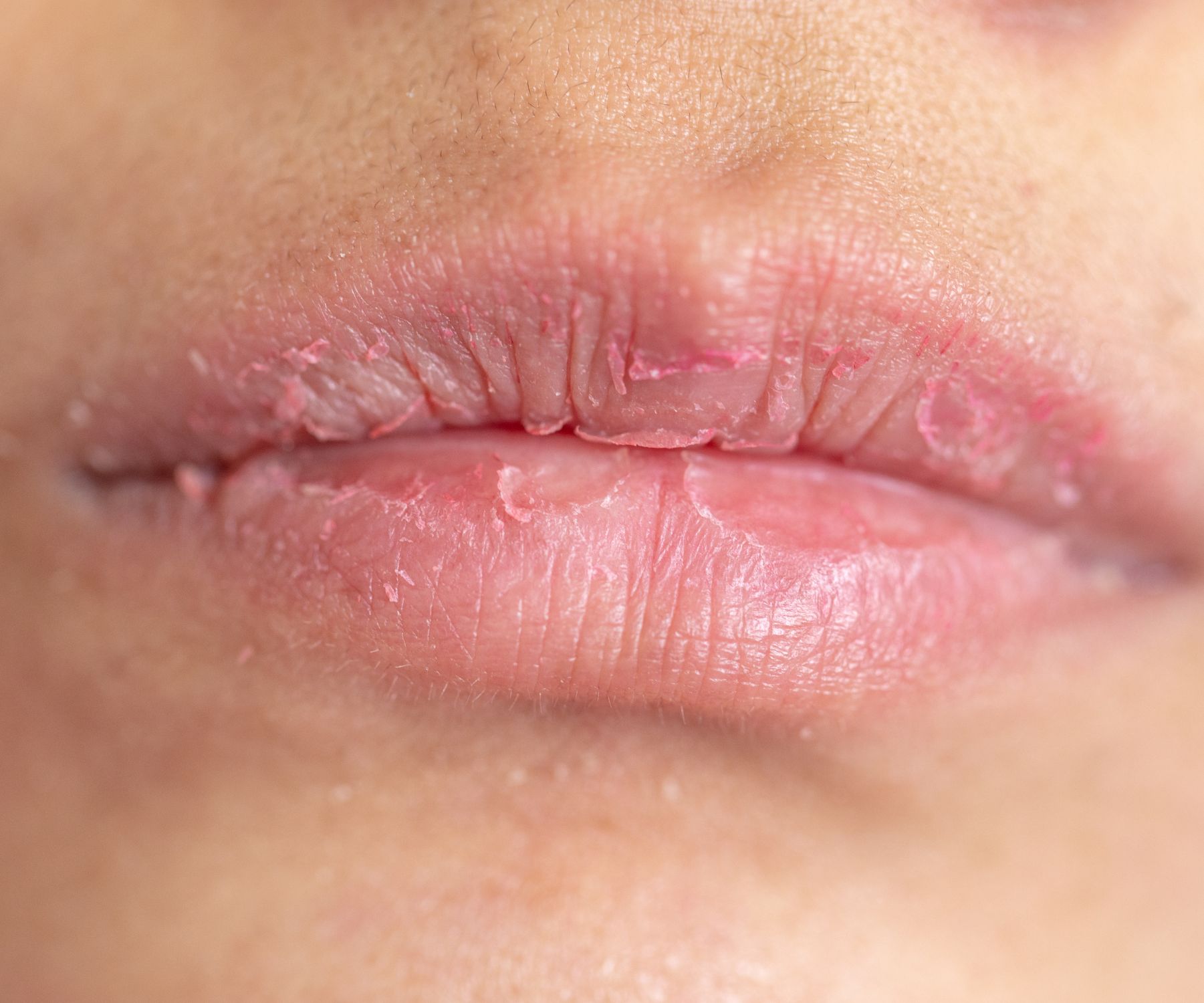 Can a Humidifier Help With Chapped Lips